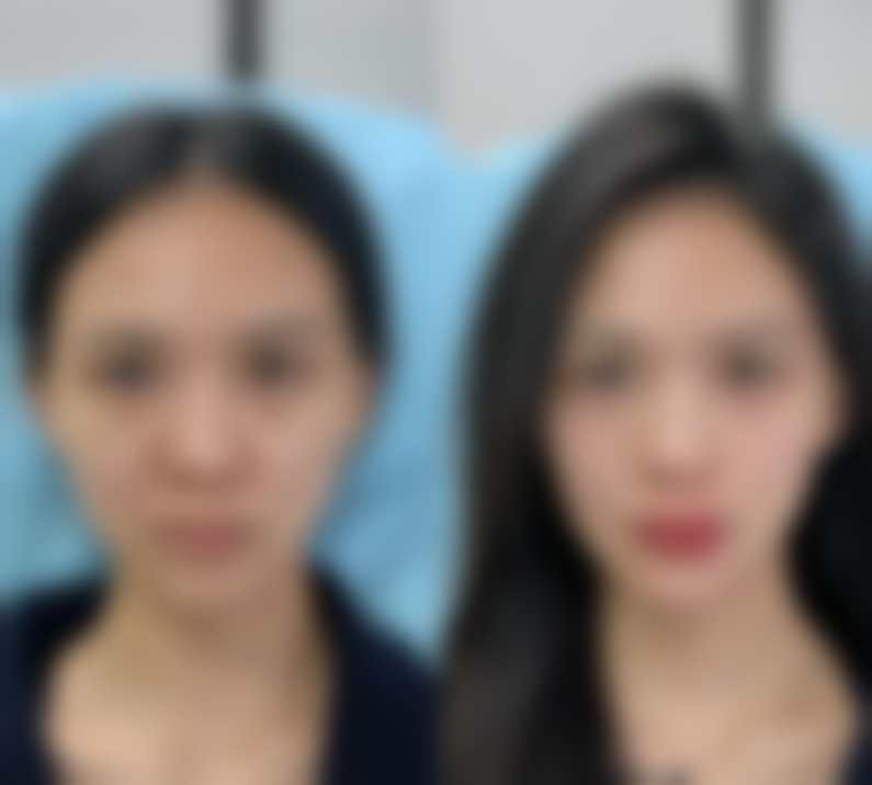 去眼袋用冰块敷管用吗？了解适用场景与注意事项，附有效改善眼袋方法及图片参考 