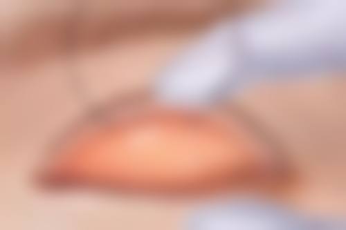 三、特殊情况如何处理?经期手术应对建议