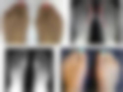 一、小腹抽脂修复时间大揭秘