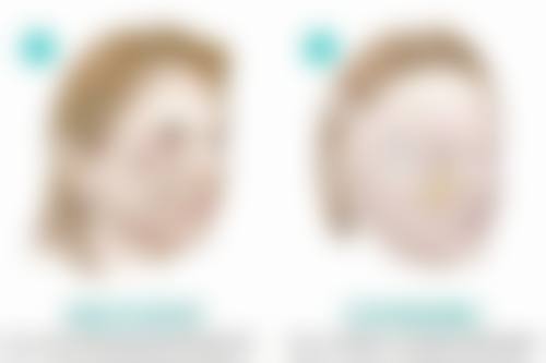 女性必看！腰腹吸脂还会反弹吗？揭秘术后不反弹的关键秘诀 