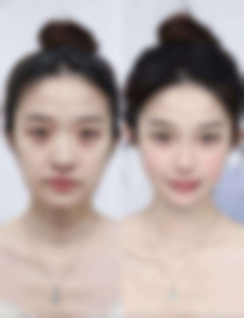 六、非经期手术的优势