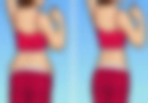 四、手术消除眼袋