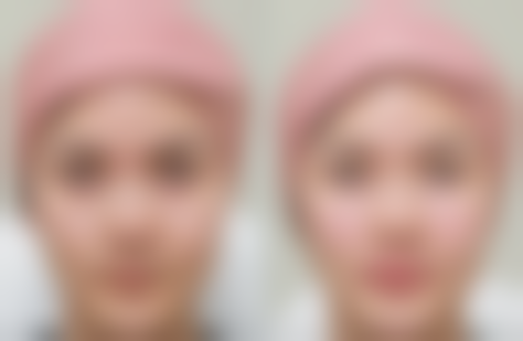 一、先天因素导致的眼袋泪沟