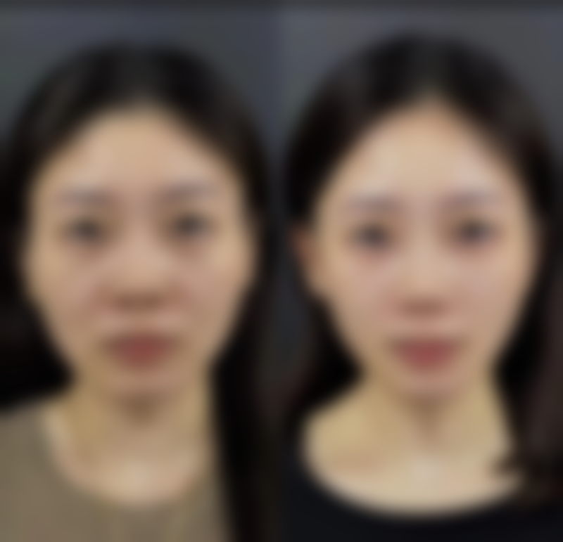 有眼袋应该怎么办？从生活调理到医美手术多途径教你有效消除眼袋