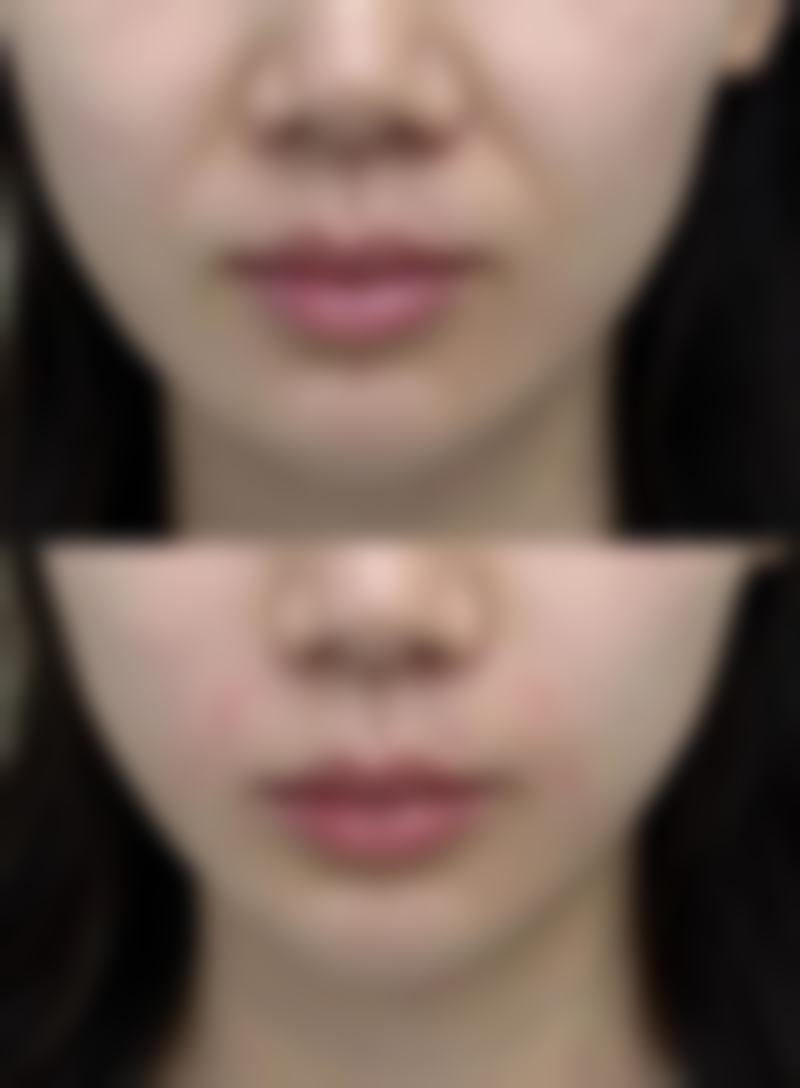 四、孩子手上疤痕挺久的日常护理建议