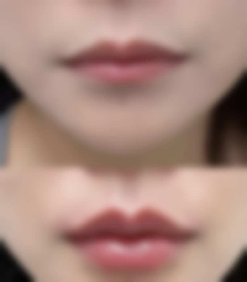 三、疤痕疙瘩痒但不一定在长的情况