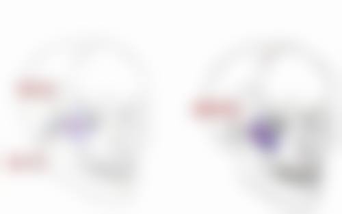 一、假体隆胸取出手术概述