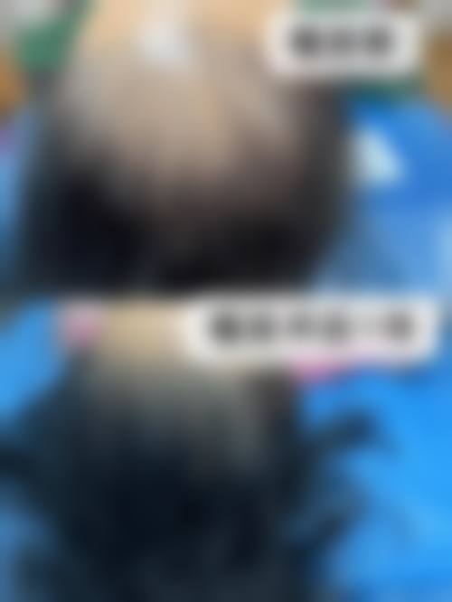 四、北京红旗中医院植发科特色项目