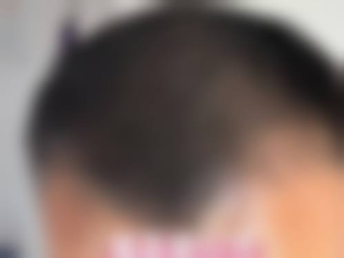 三、北京红旗中医院植发科诊疗项目有哪些？