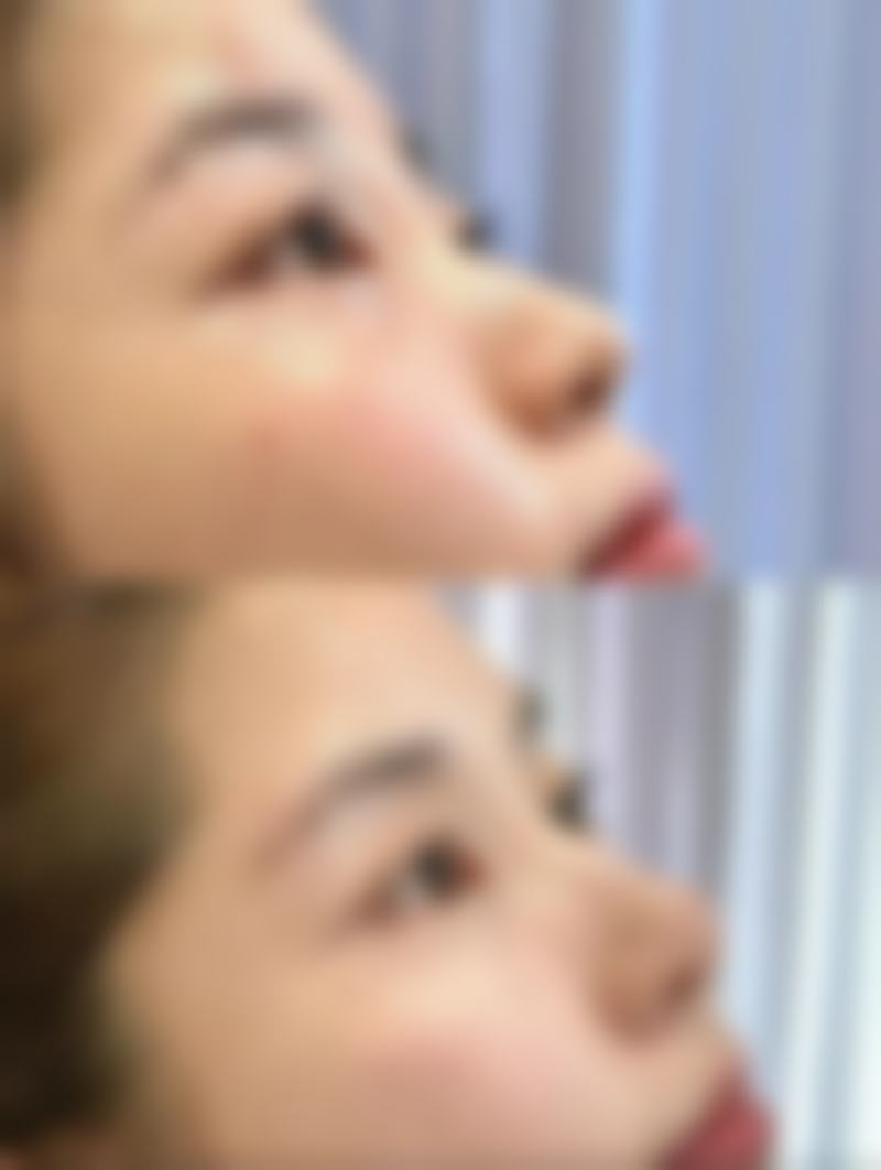 五、注射瘦脸针的美学设计要点