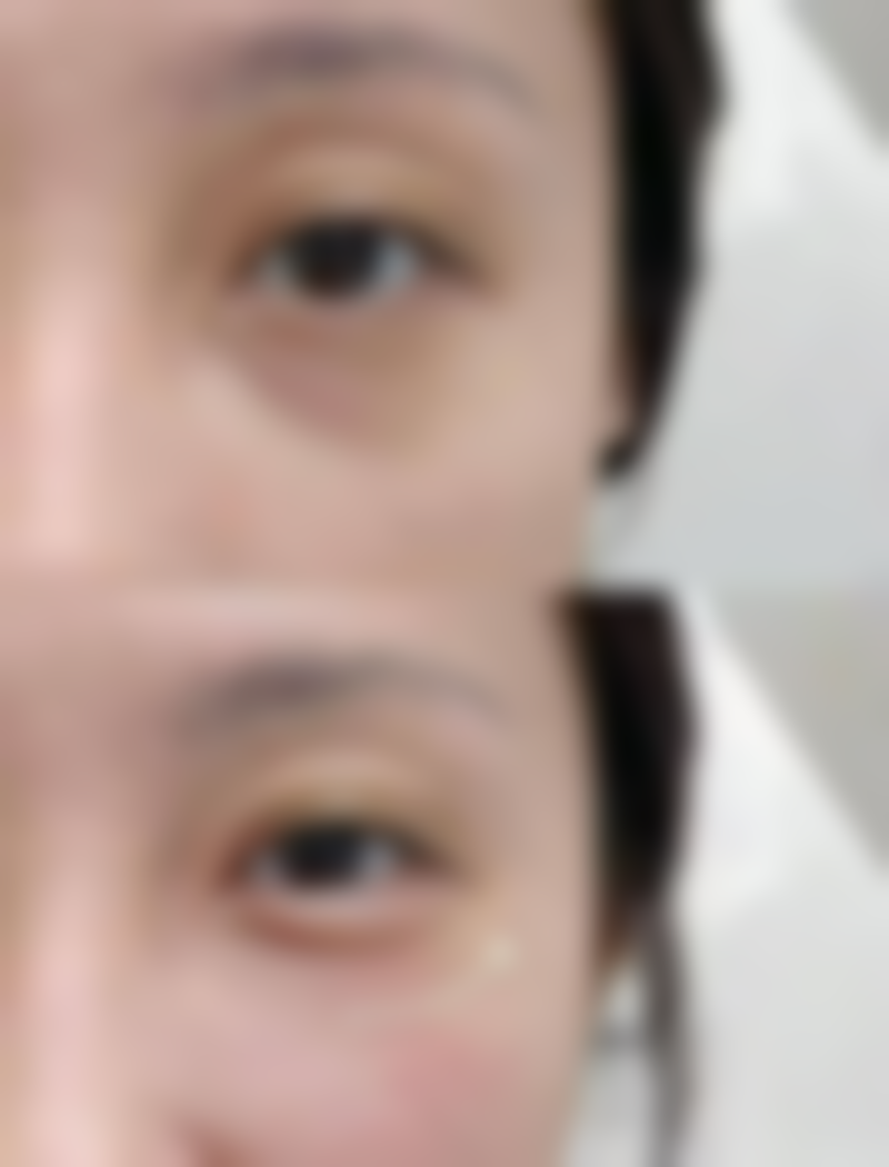 四、注射瘦脸针的成效维持时间