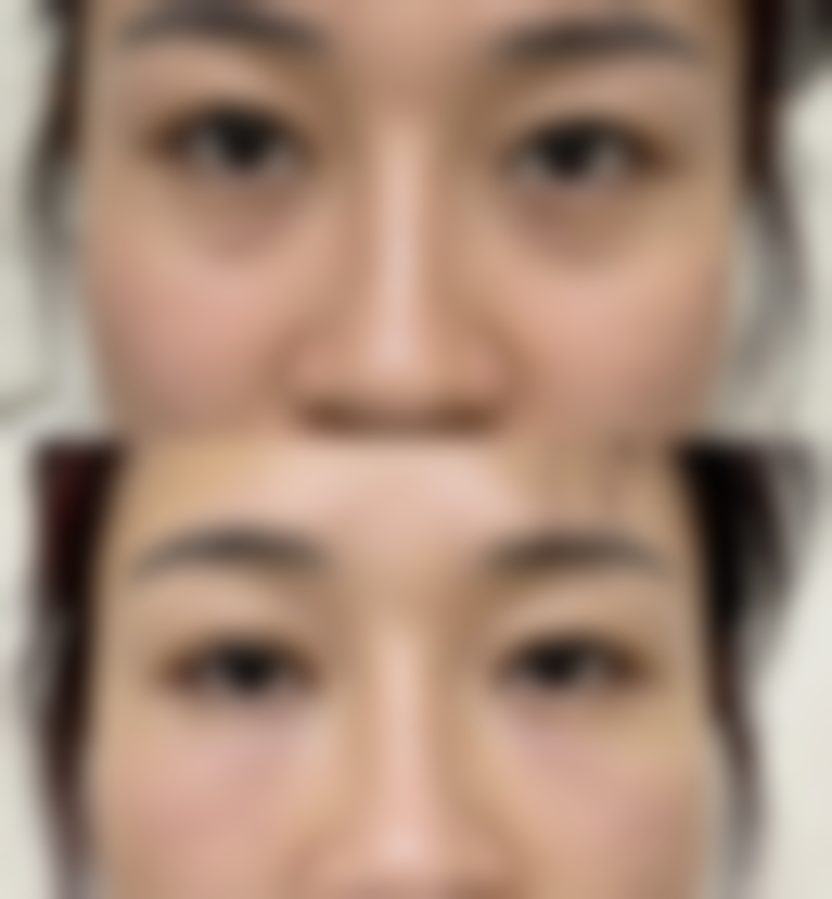 五、有恒久性注射隆鼻吗?总结与提醒