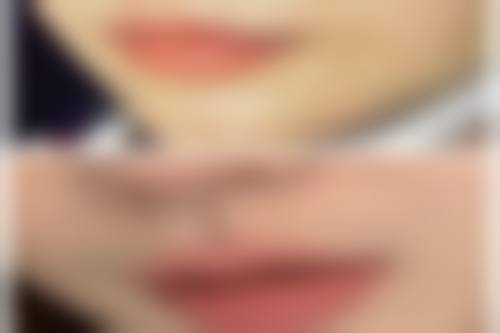 五、降低吸脂手术风险的实例:长沙吸脂医生陈仕文