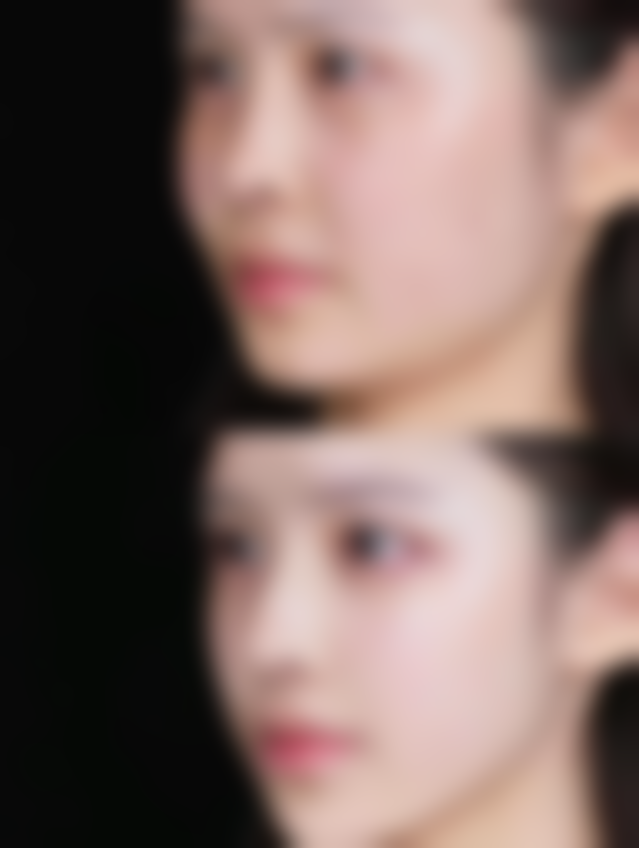 四、祛眼袋手术的成效和维持时间