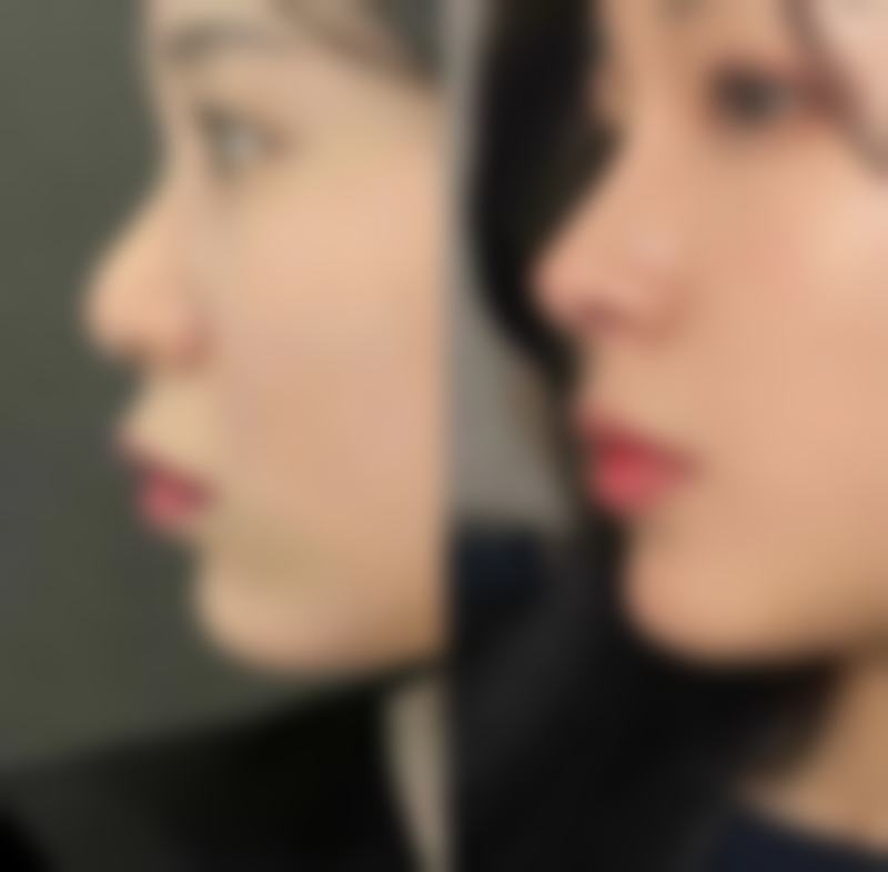 一、生姜去眼袋的原理与风险