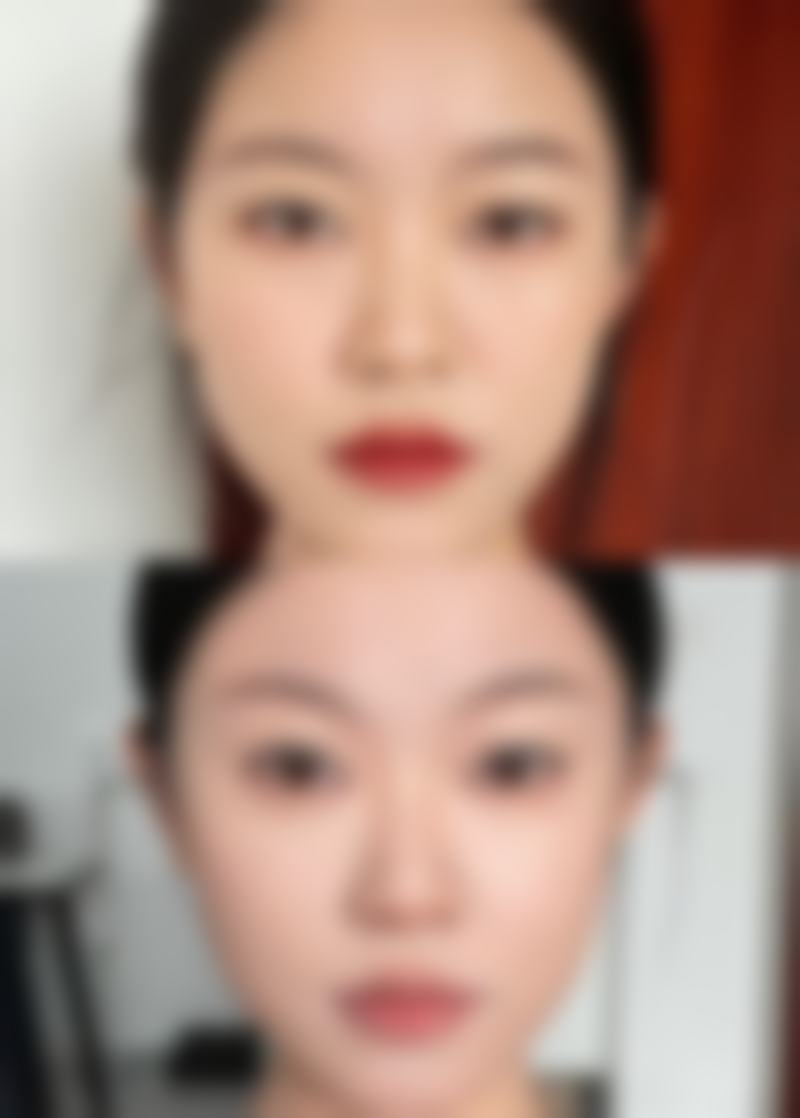 二、不同人群适合的祛眼袋手术