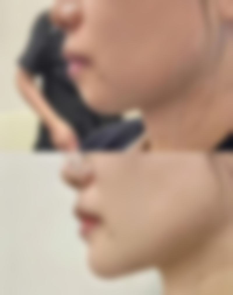 三、其他生姜去眼袋的方法