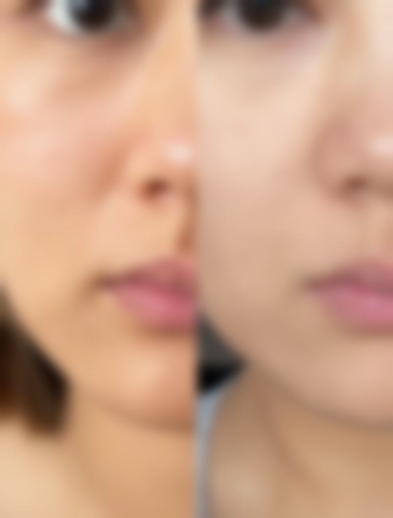 一、烫伤后红色疤痕的修复要点