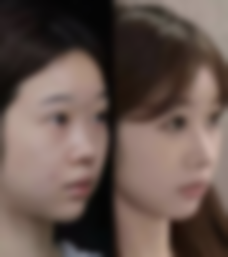 吸脂手术有没有风险？了解常见危害及应对策略，让美丽与安全同行！ 