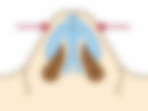 可以用别人的肋软骨隆鼻吗？排异风险、伦理问题等揭秘隆鼻材料选择要点