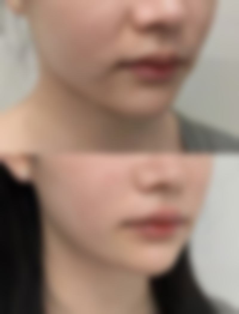 二、叶锋医生：眼袋整形的专精名咖