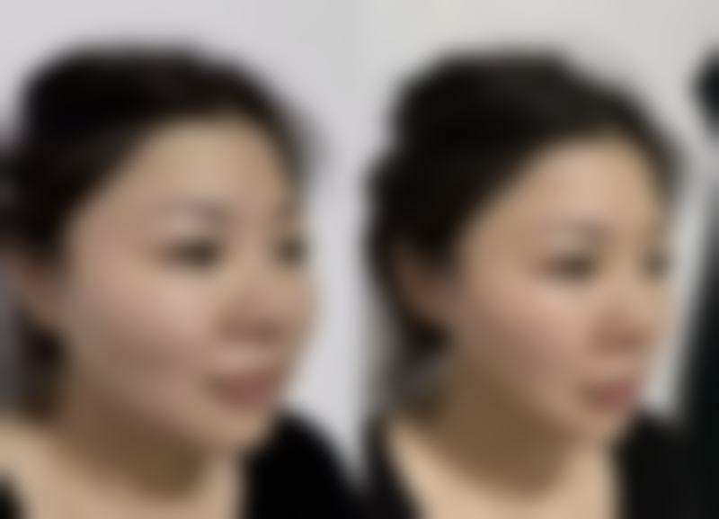 四、假体隆胸手术的修复时间