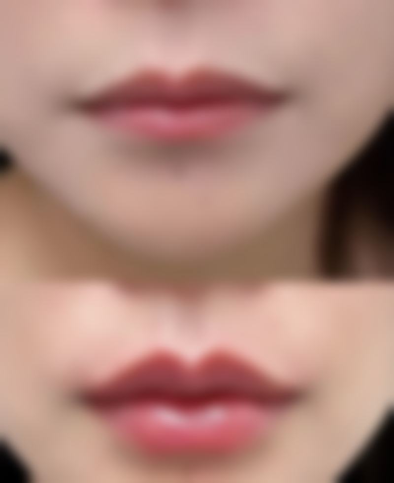 三、异体肋软骨为何被禁用？