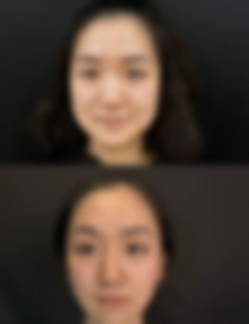 一、可以用别人的肋软骨隆鼻吗？答案大揭秘