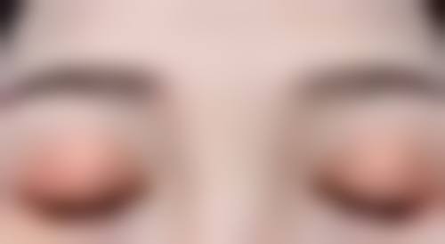 二、脸上的疤痕痘坑治疗方案对比