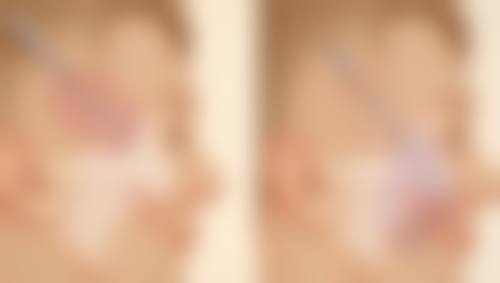 一、第二次线提升隆鼻的可行性分析