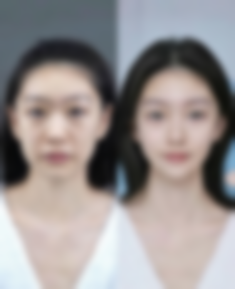 四、其他去除脸上的疤痕痘坑方法