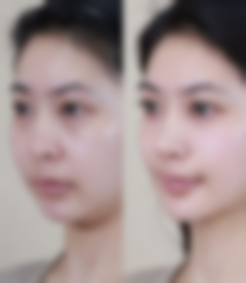 一、脸上的疤痕痘坑问题成因与分类