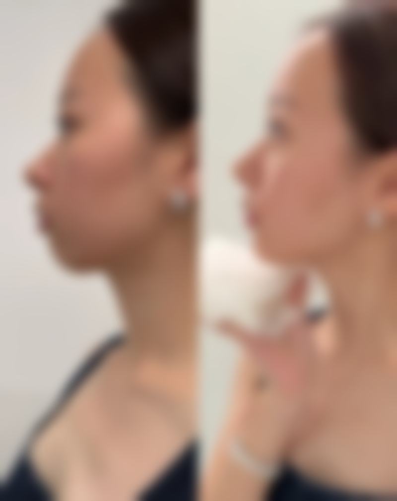 一、吃什么会长疤痕增生:饮食与疤痕修复的关联