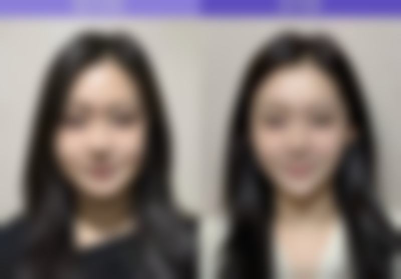 三、去眼袋手术的成效维持时长