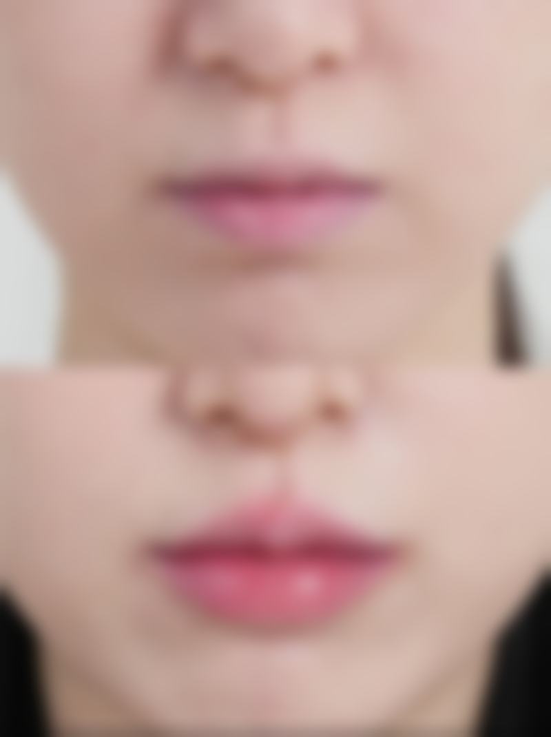 去眼袋用什么手术最好？全面解析常见术式、适用人群及效果维持时长