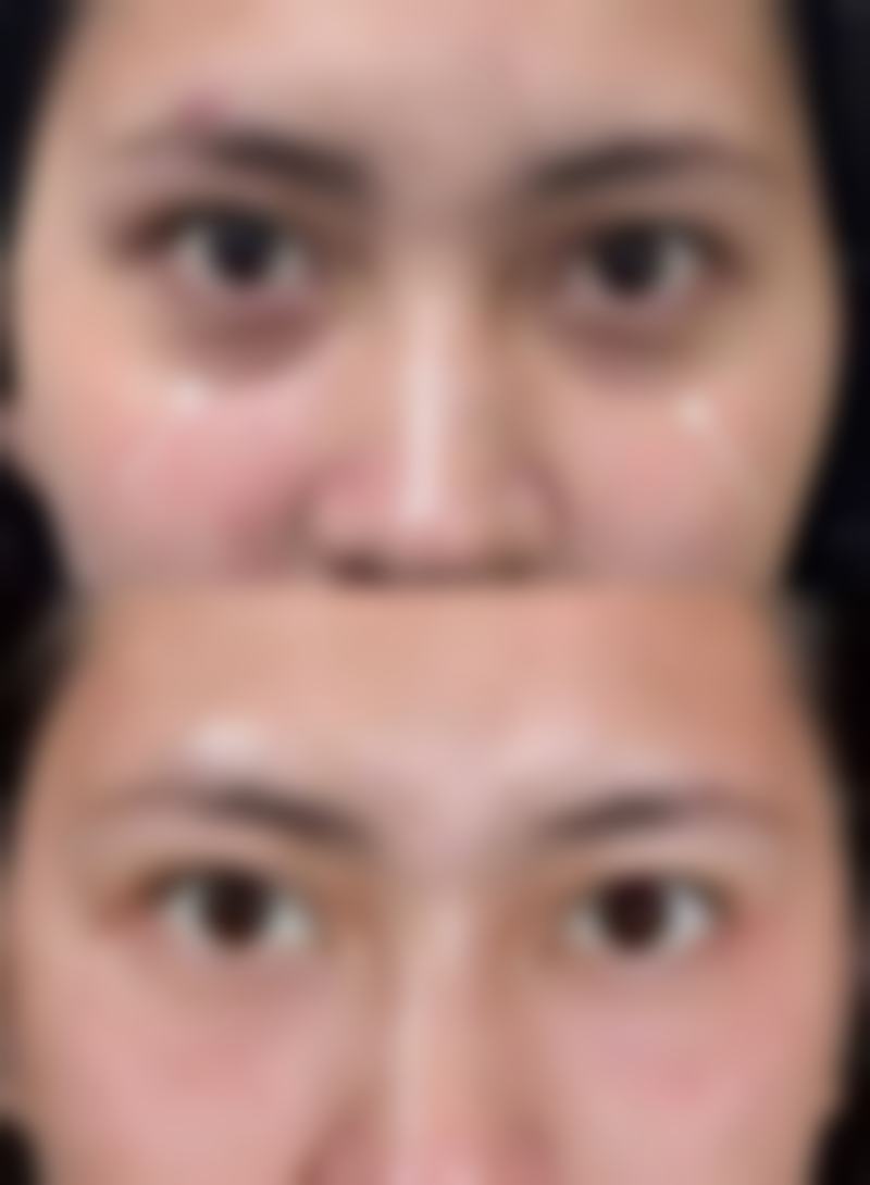 一、去眼袋手术医疗保险报销的基本规则