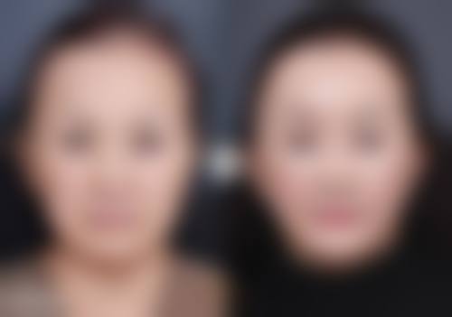 五、总结如何消除眼袋下的脂肪粒