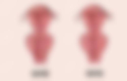 四、割双眼皮消肿过程中的常见问题及应对方法