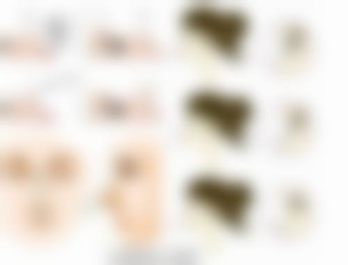 怎么去除外伤后疤痕及疤痕增生？多方案治疗与科学护理助你恢复平整肌肤 