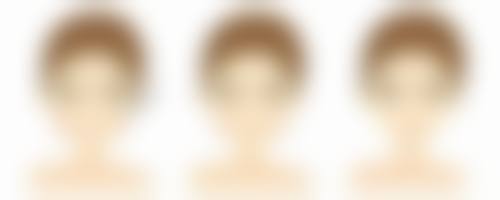 祛眼袋效果如何？不同类型眼袋选对方法效果好，手术与非手术各有优势 