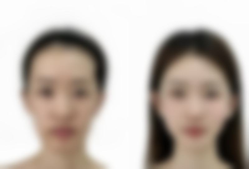 二、打一针瘦脸针后面不打有影响吗？常见变化