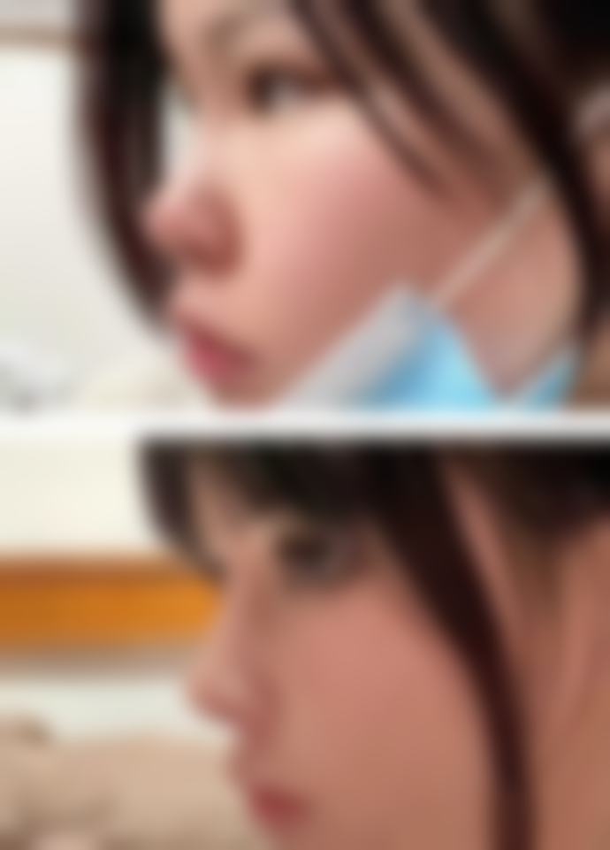 一、瘦脸针的作用原理