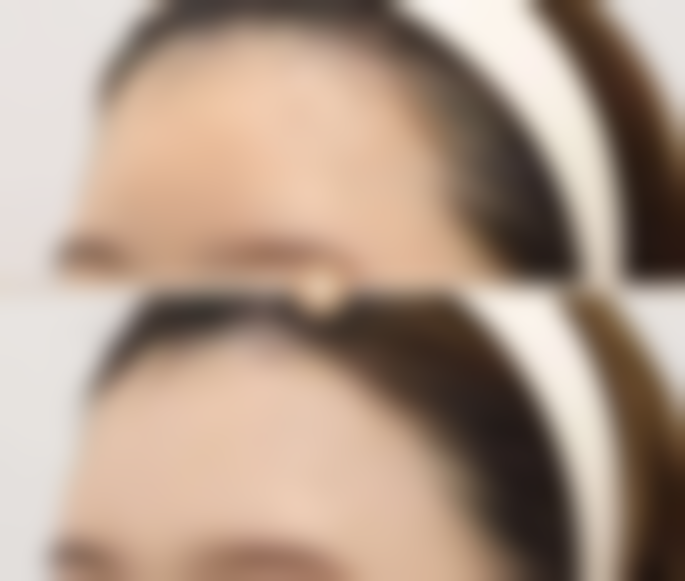 三、怎么进行去除外伤后疤痕的药物治疗