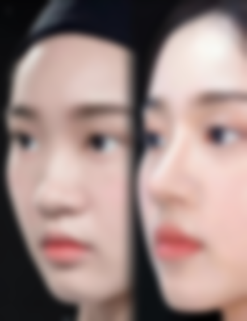 容易留痘坑是疤痕体质吗？揭开女性长痘留坑真相，深度解析两者关联