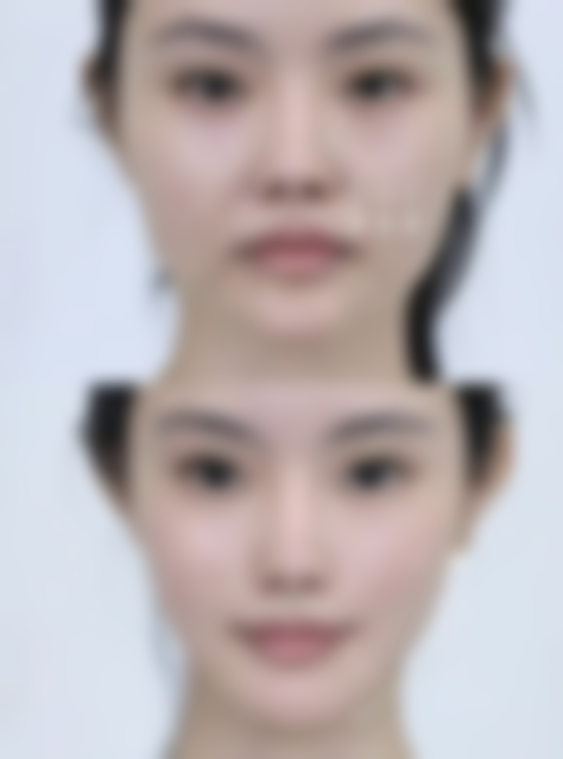 三、去除脸部色素疤痕的药物治疗方法