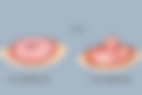 五、做了双眼皮喝消肿汤的注意事项