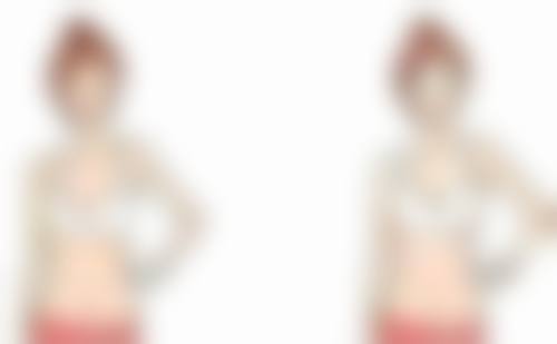 四、做完双眼皮生理期拆线的注意事项