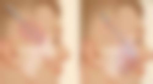 一、能不能只割一个双眼皮之手术可行性分析