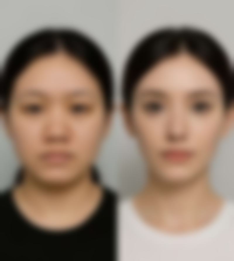 五、瘦脸针的替代方案