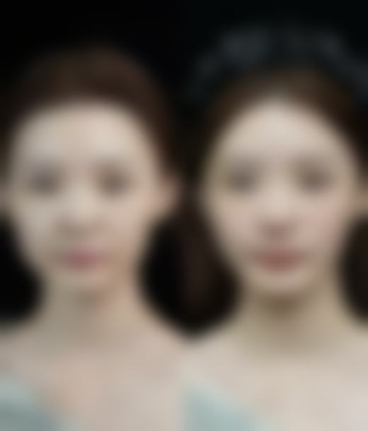 一、做完双眼皮后拆线时间的常规情况